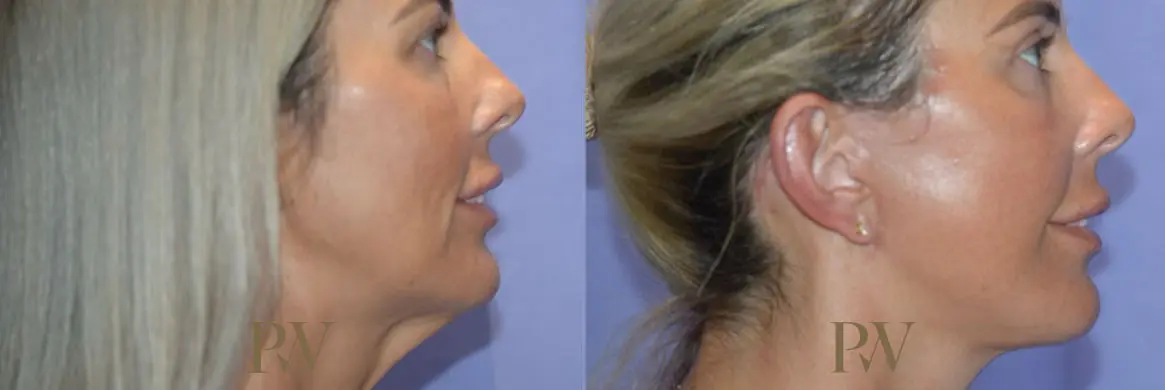 Paul Wilson - Deep Plane Facelift Patient Image 2