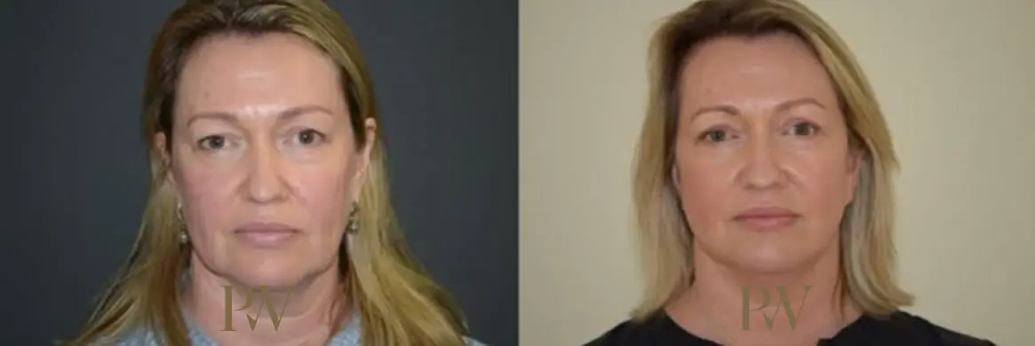 Paul Wilson - Deep Plane Facelift Patient Image 21