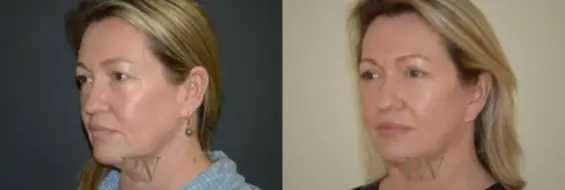 Paul Wilson - Deep Plane Facelift Patient Image 22