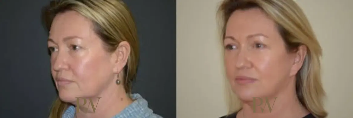 Paul Wilson - Deep Plane Facelift Patient Image 22