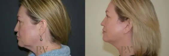 Paul Wilson - Deep Plane Facelift Patient Image 23