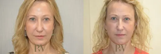 Paul Wilson - Deep Plane Facelift Patient Image 24