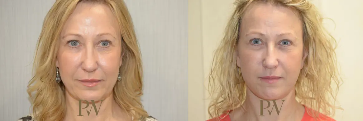 Paul Wilson - Deep Plane Facelift Patient Image 24