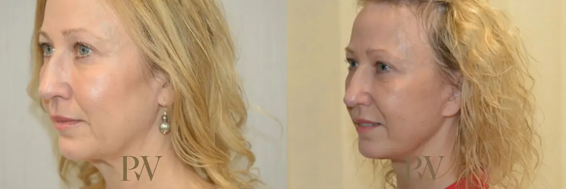 Paul Wilson - Deep Plane Facelift Patient Image 25