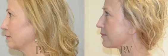 Paul Wilson - Deep Plane Facelift Patient Image 26