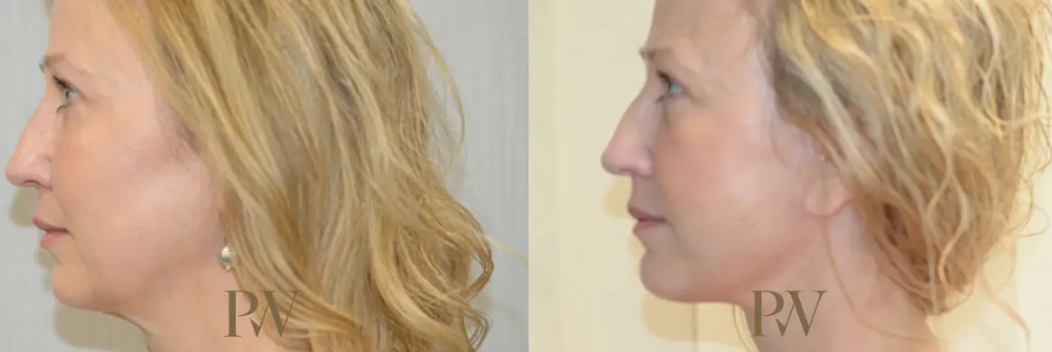 Paul Wilson - Deep Plane Facelift Patient Image 26