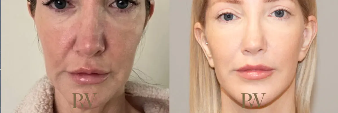 Paul Wilson - Deep Plane Facelift Patient Image 27