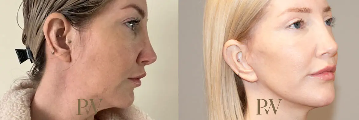 Paul Wilson - Deep Plane Facelift Patient Image 28