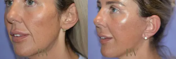 Paul Wilson - Deep Plane Facelift Patient Image 3