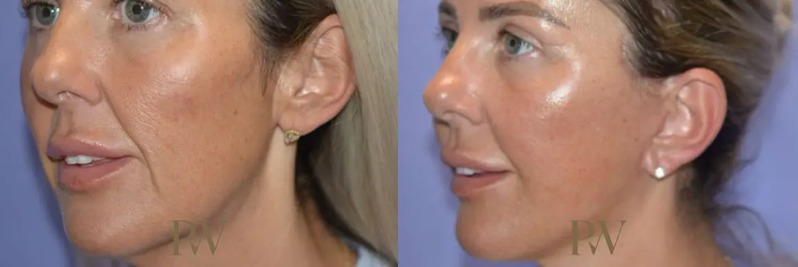 Paul Wilson - Deep Plane Facelift Patient Image 3