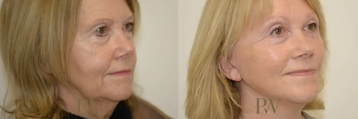 Paul Wilson - Deep Plane Facelift Patient Image 4