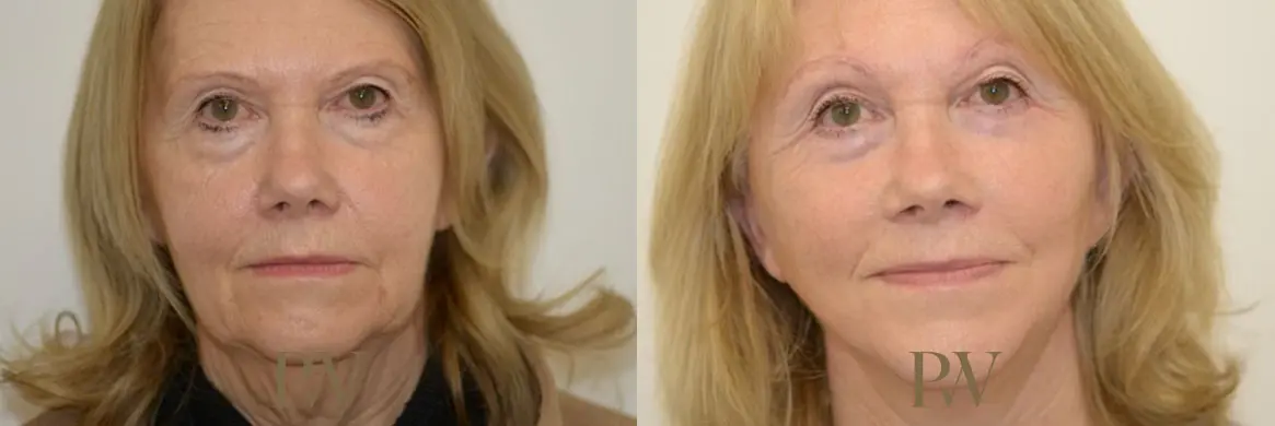 Paul Wilson - Deep Plane Facelift Patient Image 5