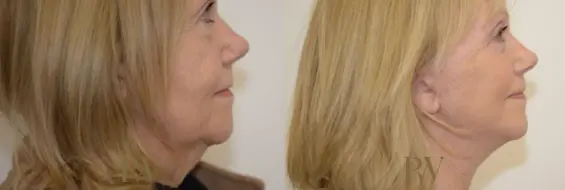 Paul Wilson - Deep Plane Facelift Patient Image 6