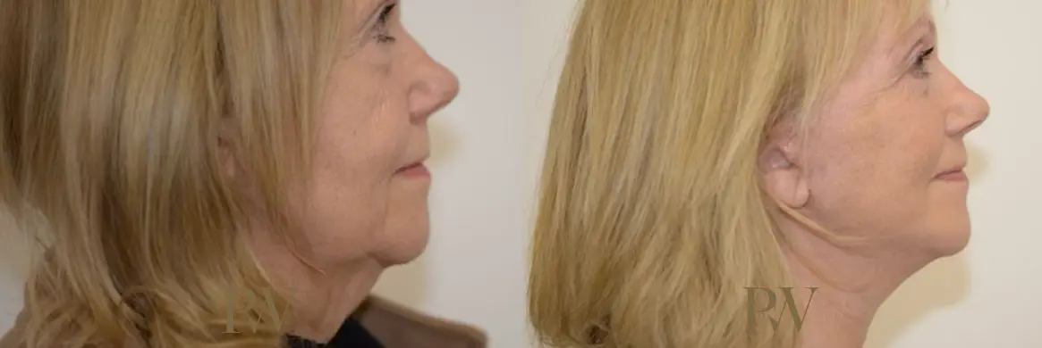 Paul Wilson - Deep Plane Facelift Patient Image 6