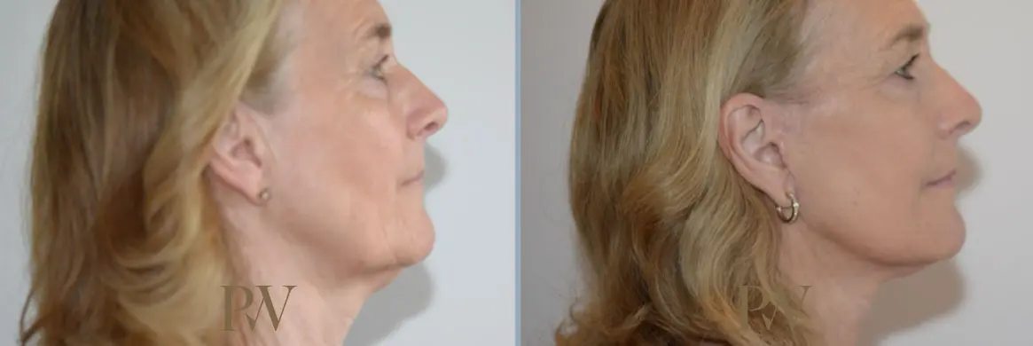 Paul Wilson - Deep Plane Facelift Patient Image 7