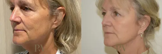 Paul Wilson - Deep Plane Facelift Patient Image 9