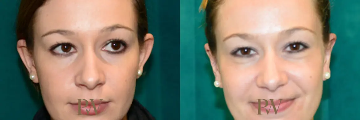 Paul Wilson - Ear Reshaping (Otoplasty) Patient Image 1