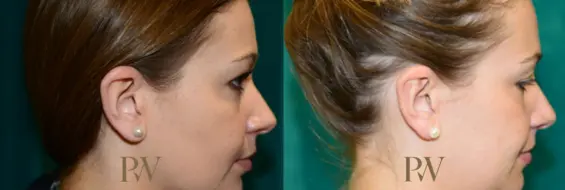 Paul Wilson - Ear Reshaping (Otoplasty) Patient Image 2