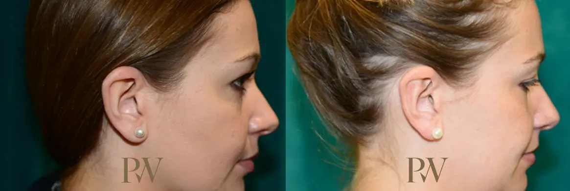 Paul Wilson - Ear Reshaping (Otoplasty) Patient Image 2