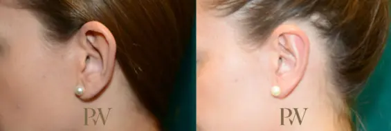 Paul Wilson - Ear Reshaping (Otoplasty) Patient Image 3
