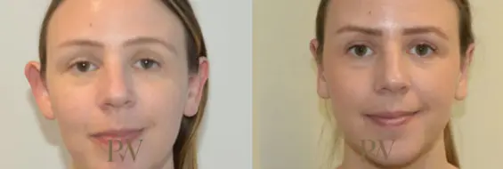 Paul Wilson - Ear Reshaping (Otoplasty) Patient Image 4