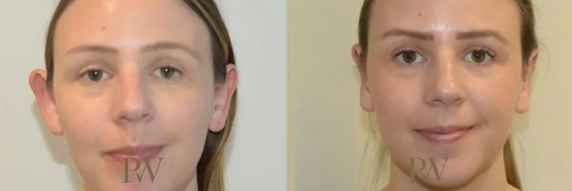 Paul Wilson - Ear Reshaping (Otoplasty) Patient Image 4