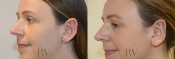 Paul Wilson - Ear Reshaping (Otoplasty) Patient Image 5