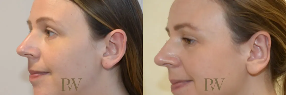 Paul Wilson - Ear Reshaping (Otoplasty) Patient Image 5