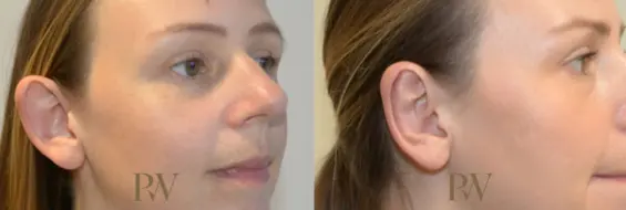 Paul Wilson - Ear Reshaping (Otoplasty) Patient Image 6