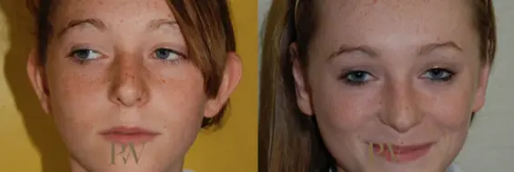 Paul Wilson - Ear Reshaping (Otoplasty) Patient Image 7