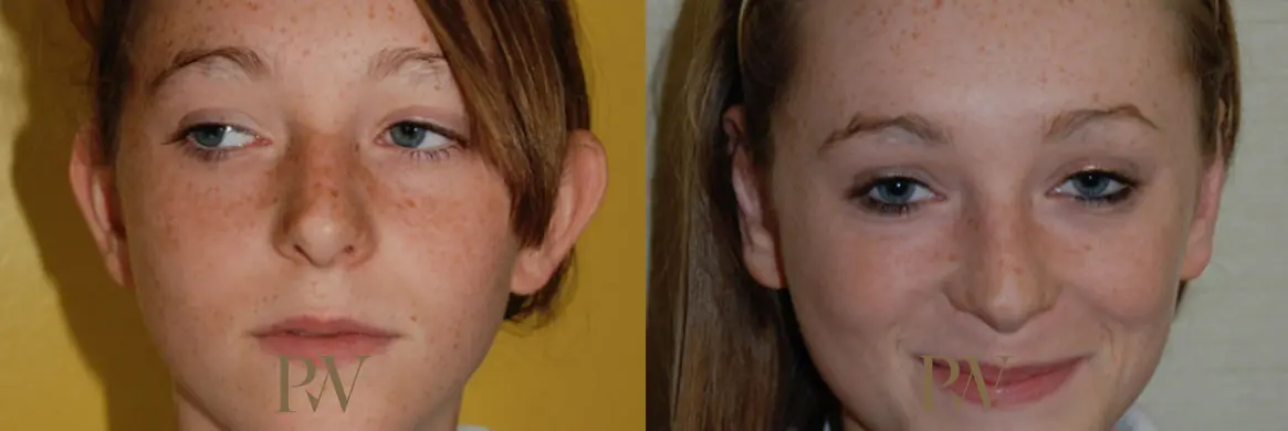 Paul Wilson - Ear Reshaping (Otoplasty) Patient Image 7