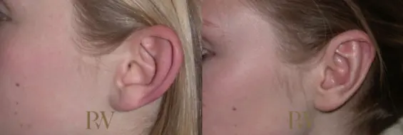 Paul Wilson - Ear Reshaping (Otoplasty) Patient Image 8