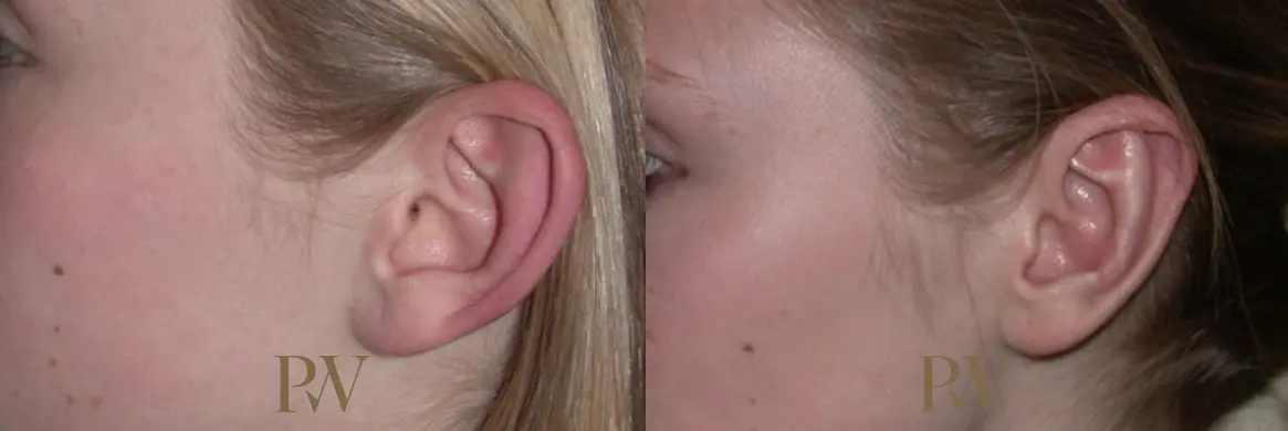 Paul Wilson - Ear Reshaping (Otoplasty) Patient Image 8