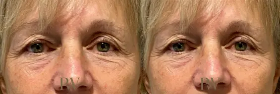 Paul Wilson - Eyelid Surgery Patient Image 1