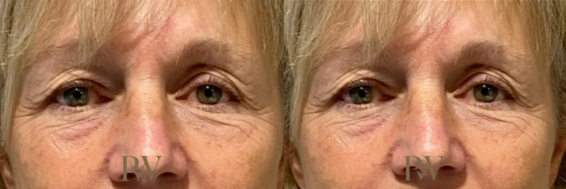 Paul Wilson - Eyelid Surgery Patient Image 1