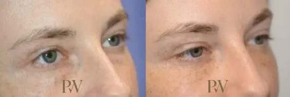 Paul Wilson - Eyelid Surgery Patient Image 10