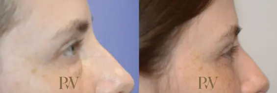 Paul Wilson - Eyelid Surgery Patient Image 11