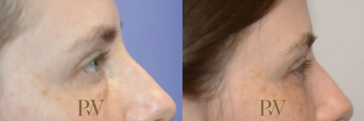 Paul Wilson - Eyelid Surgery Patient Image 11