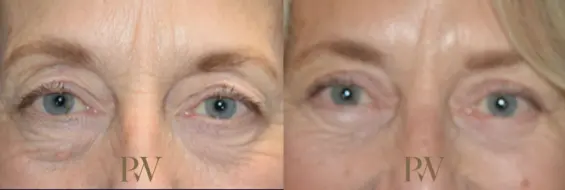 Paul Wilson - Eyelid Surgery Patient Image 12