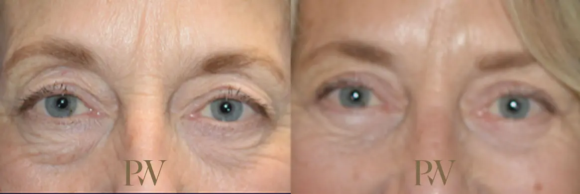 Paul Wilson - Eyelid Surgery Patient Image 12