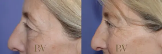 Paul Wilson - Eyelid Surgery Patient Image 13