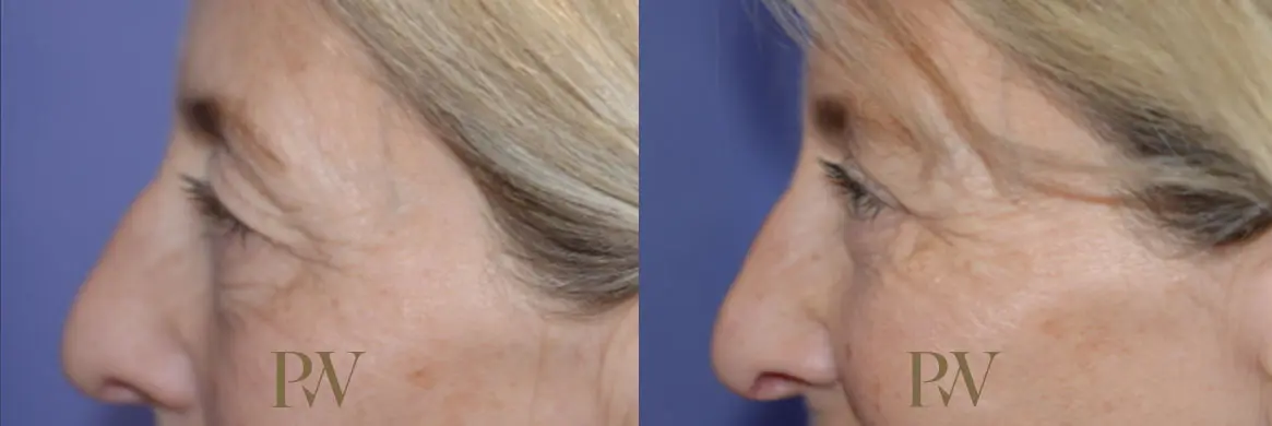 Paul Wilson - Eyelid Surgery Patient Image 13