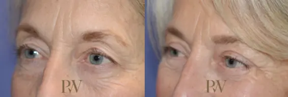 Paul Wilson - Eyelid Surgery Patient Image 14