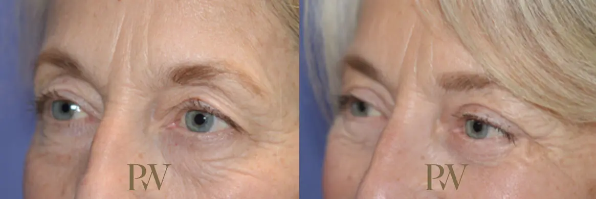 Paul Wilson - Eyelid Surgery Patient Image 14