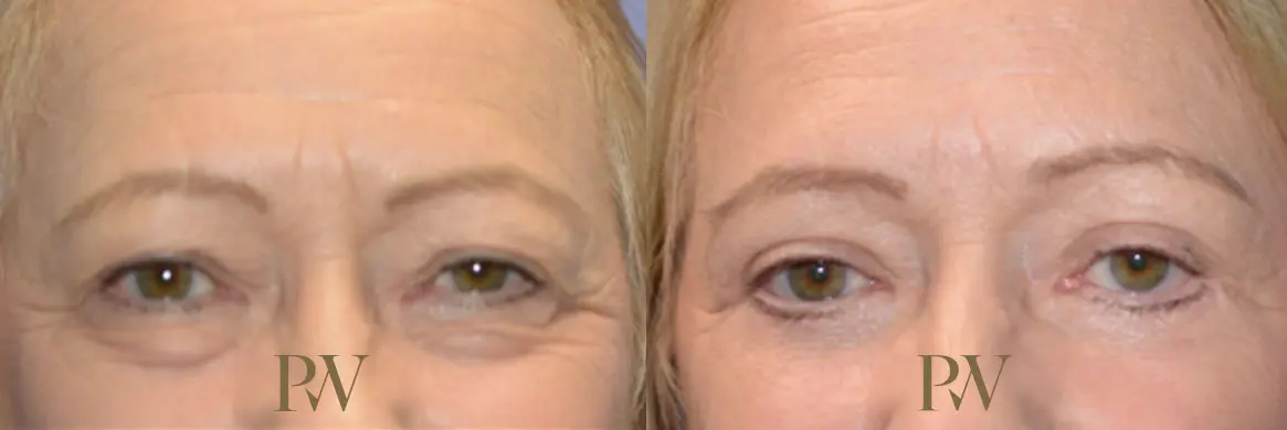 Paul Wilson - Eyelid Surgery Patient Image 15