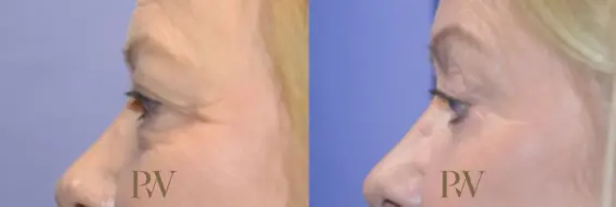 Paul Wilson - Eyelid Surgery Patient Image 16