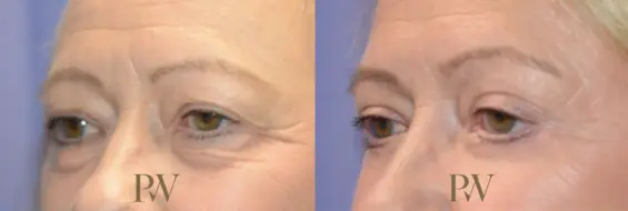 Paul Wilson - Eyelid Surgery Patient Image 17