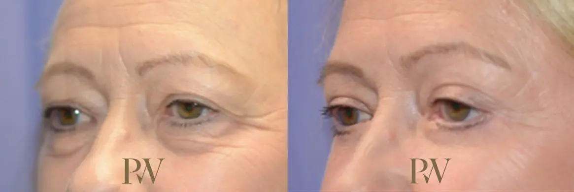 Paul Wilson - Eyelid Surgery Patient Image 17