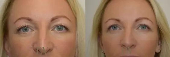 Paul Wilson - Eyelid Surgery Patient Image 18