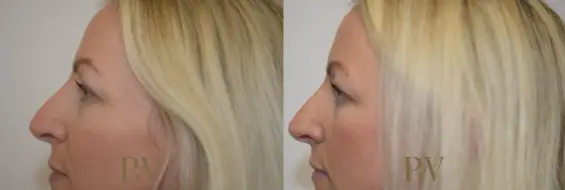 Paul Wilson - Eyelid Surgery Patient Image 19